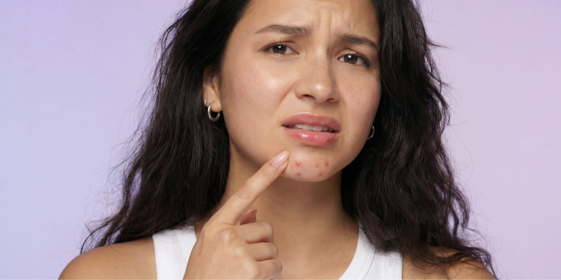 Woman pointing to inflamed acne breakouts on her chin during a stress-related hormonal flare-up.