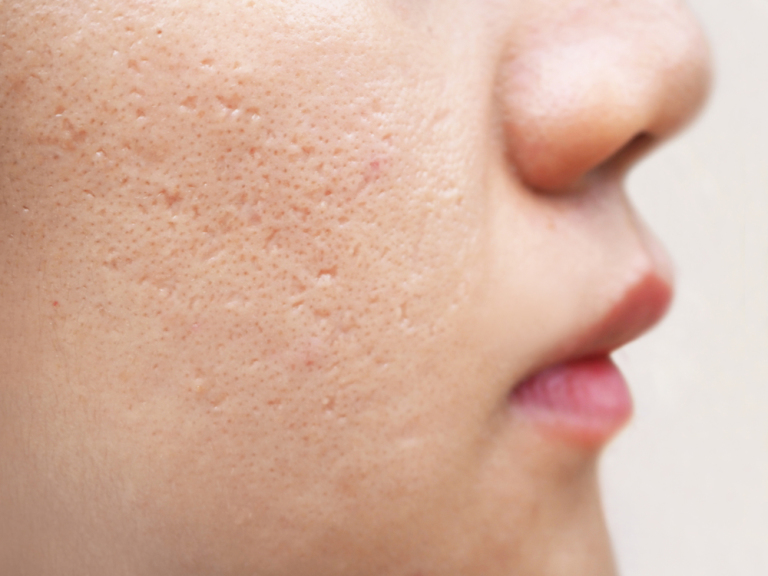 Icepick scars acne in the cheek of a woman