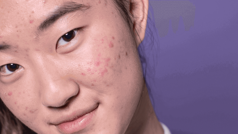 Acne Can Cause Uneven Skin Tones