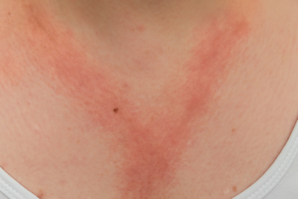 Dermatitis allergic contact - Everything you need to know about irritated skin
