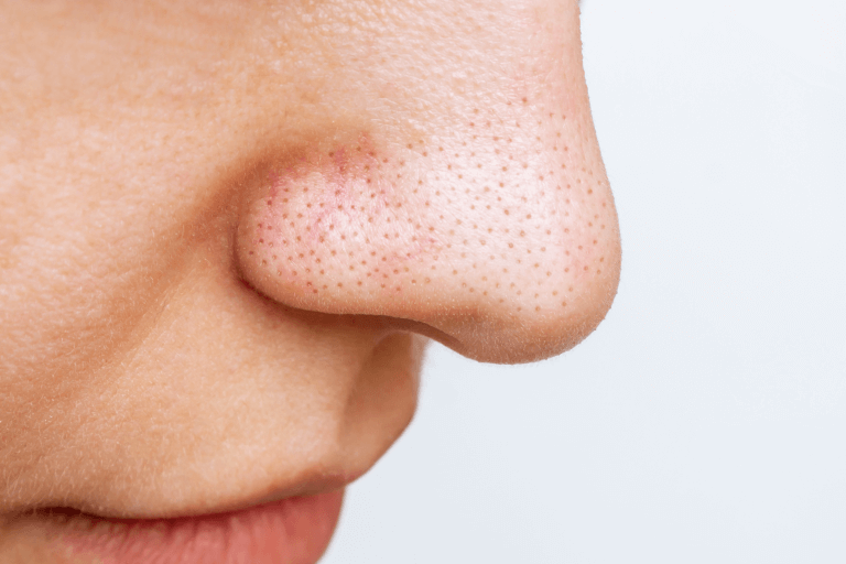 Blackheads are comedones that can be extracted