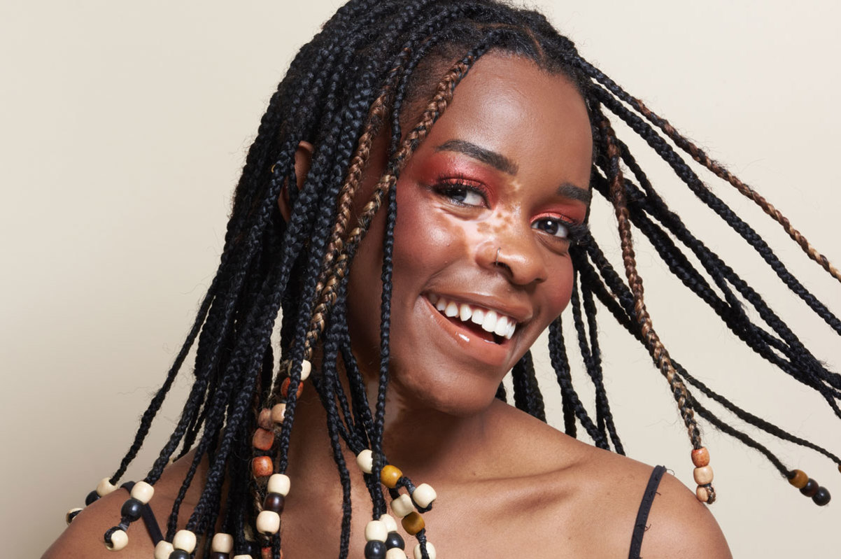 smiley woman with vitiligo on her skin