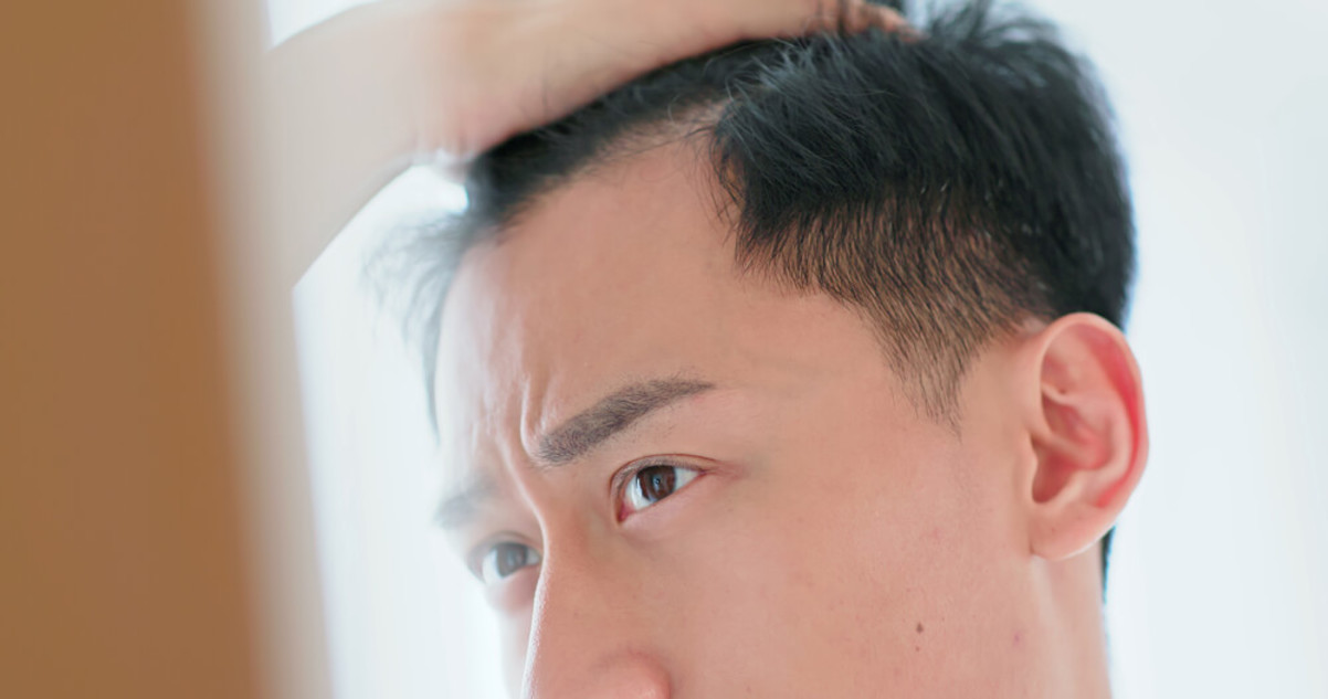 Man Worried About Hair Loss