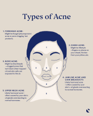 Acne face mapping: What your skin is trying to tell you | Curology