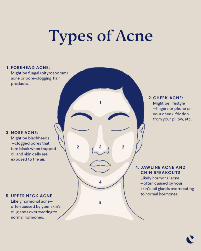 Acne Face Mapping What Your Skin Is Trying To Tell You Curology