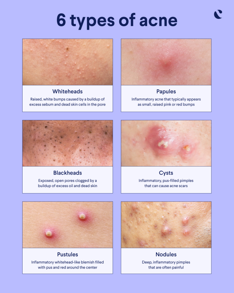 Types of Acne Blog Graphic