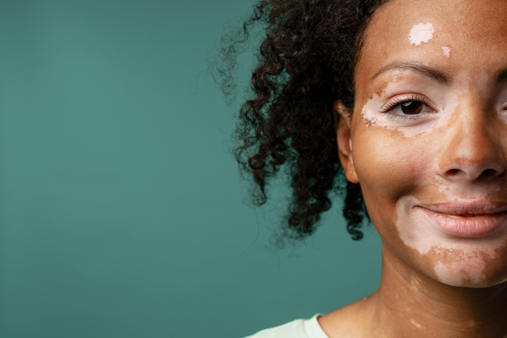 smiling woman with vitiligo on her face