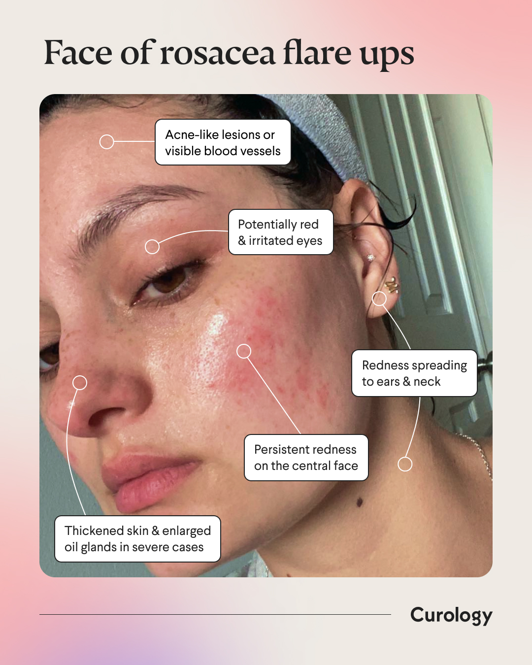 Acne Rosacea Face Mapping 