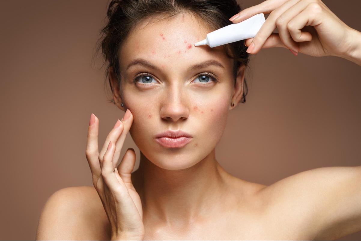 Teen Girl with Problem Skin Applying Treatment Cream on Beige Background. Skincare Concept