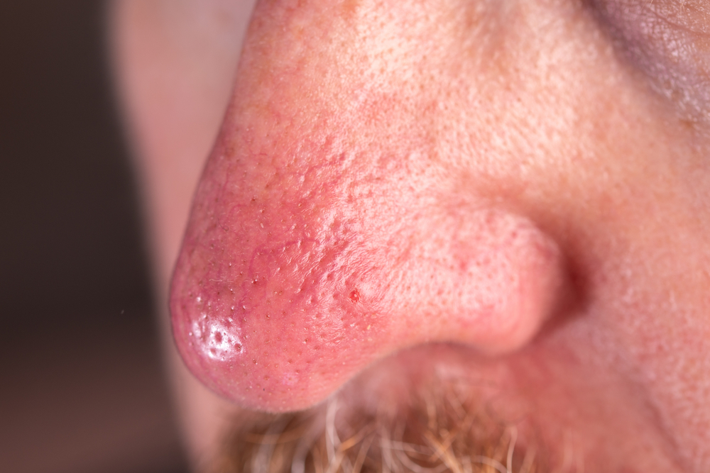 nose with rosacea condition on it
