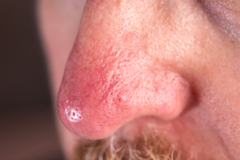 nose with rosacea condition on it