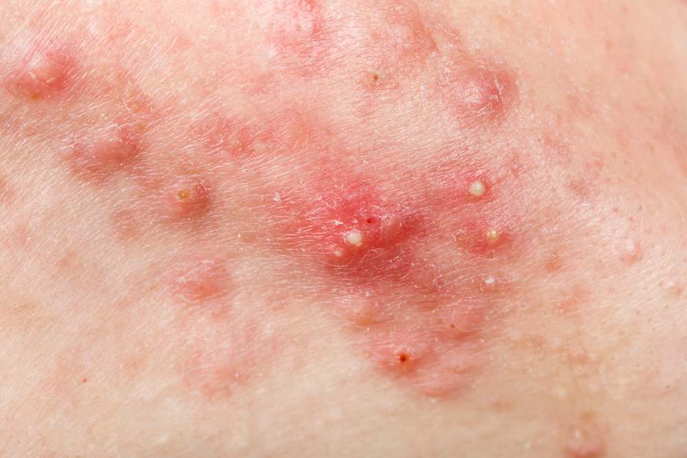 nodular-cystic-acne-skin