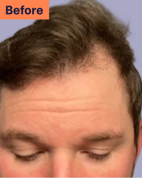 Tom Before Hair Loss