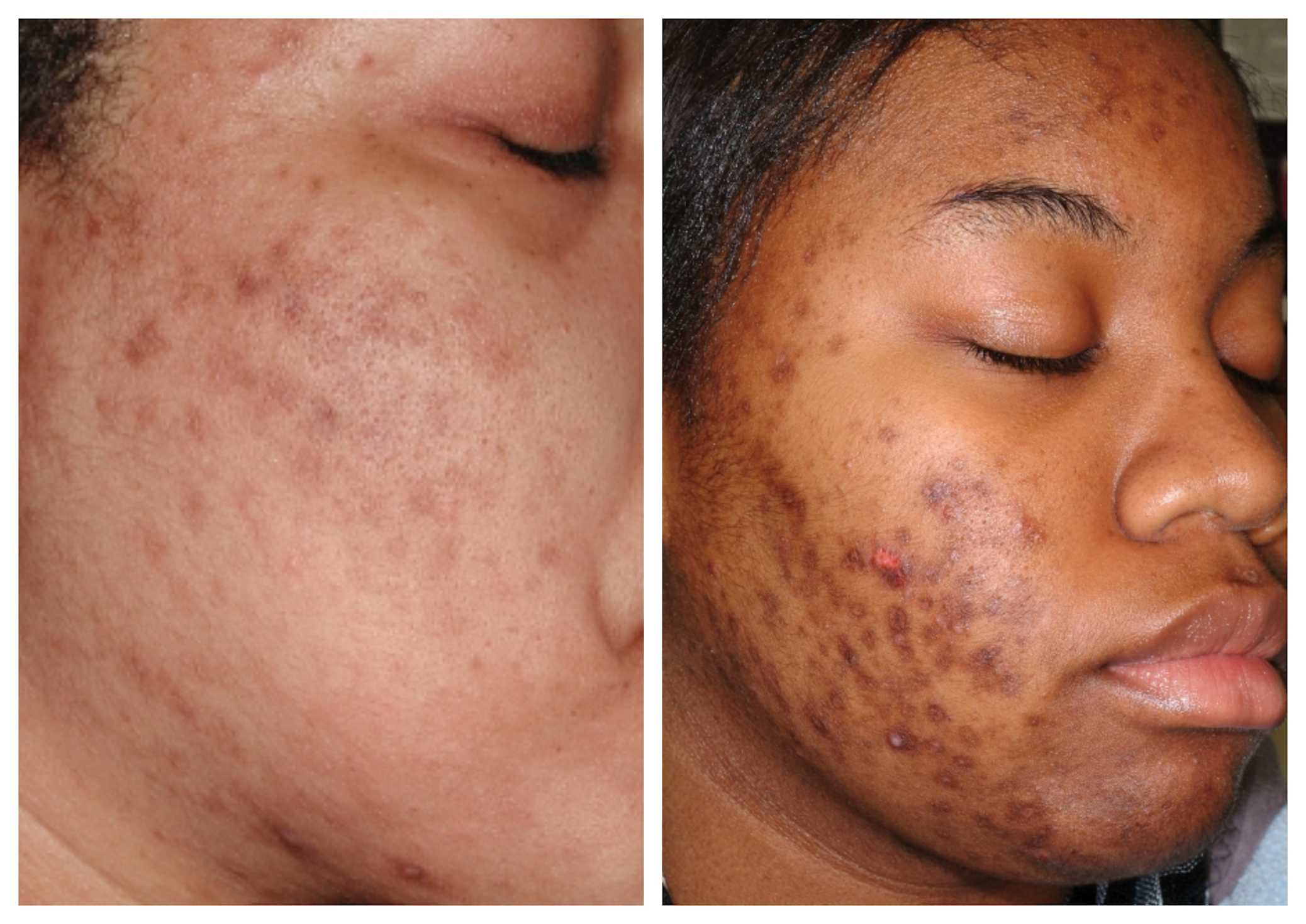 sunscreen and dark spots
