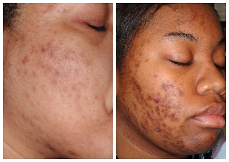 Two women with hyperpigmentation on their face