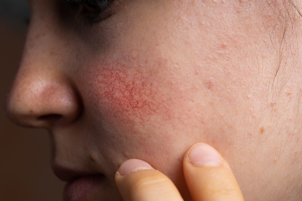 Closeup-shot-rosacea-redness-on-cheek