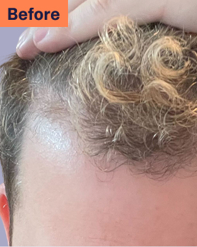 Alejandro Before Hair Loss