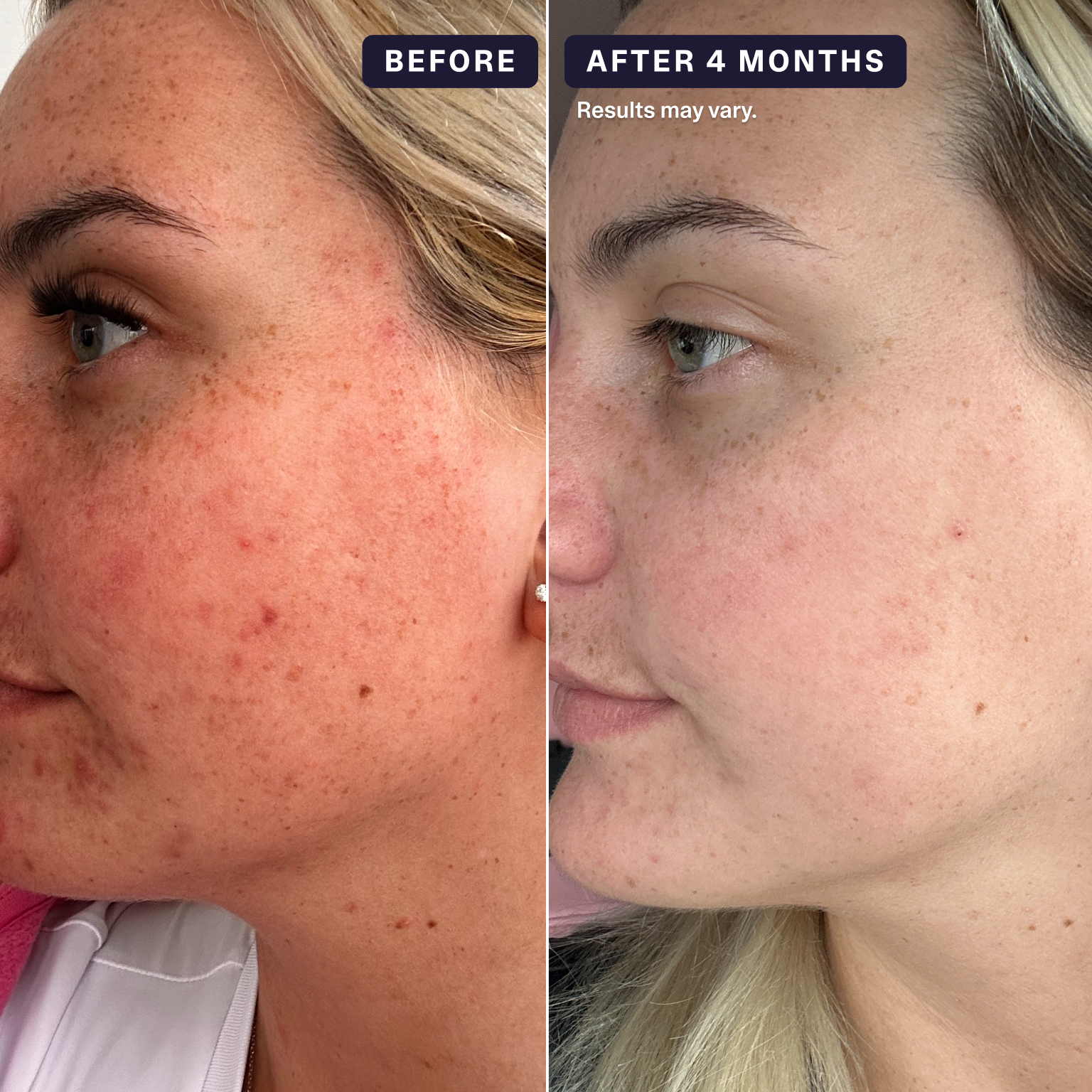 Curology Custom Formula Rx before and after photo