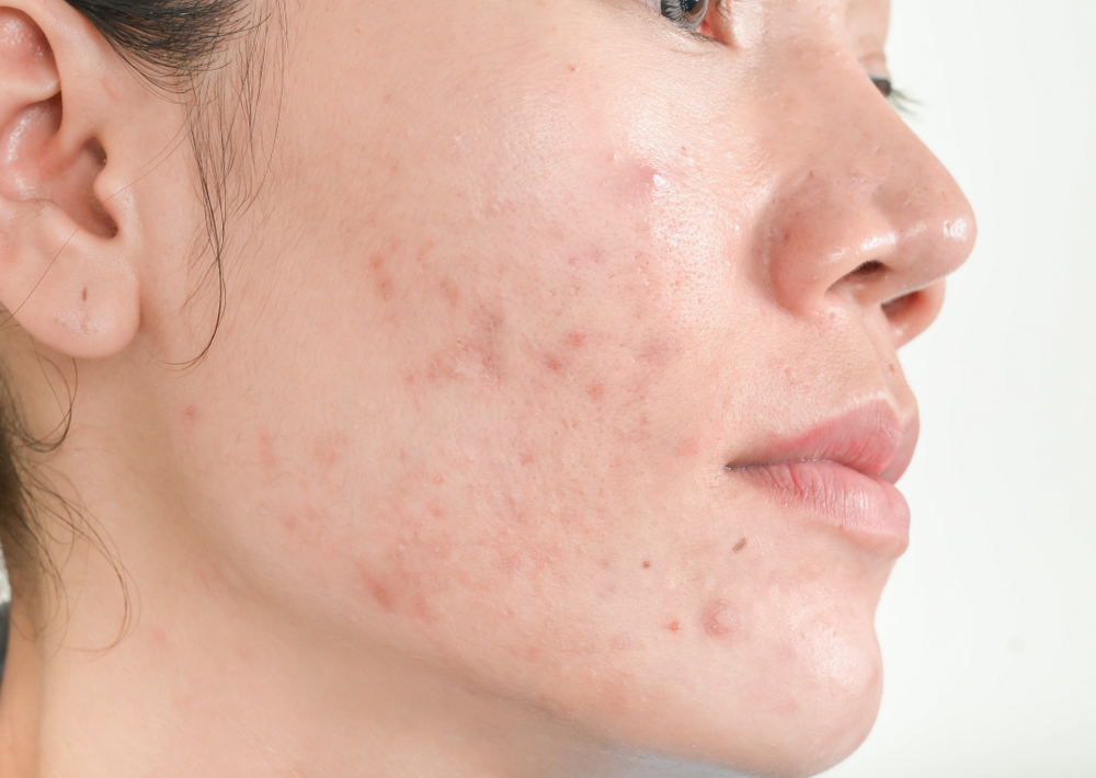 scar acne on face