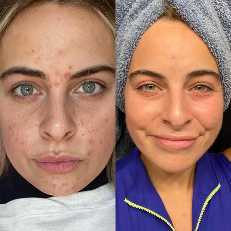 Lynae Elizabeth's face Before and After Curology