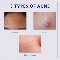 Types of acne: blackheads, whiteheads, fungal, cysts + more
