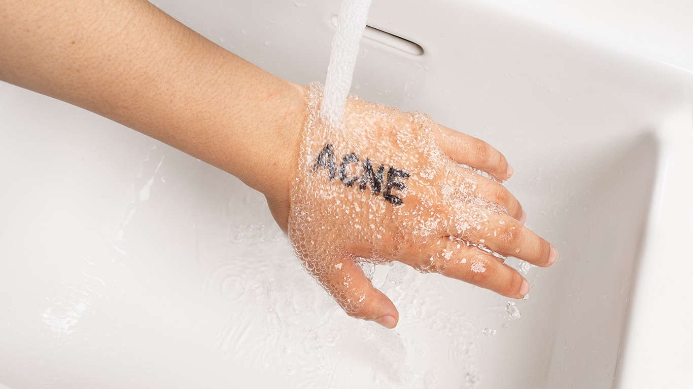 Hand under water with the word "acne" 