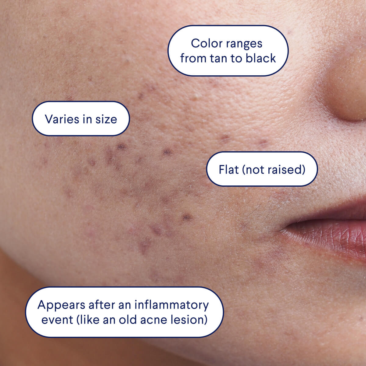 Acne Spots Post-inflammatory hyperpigmentation