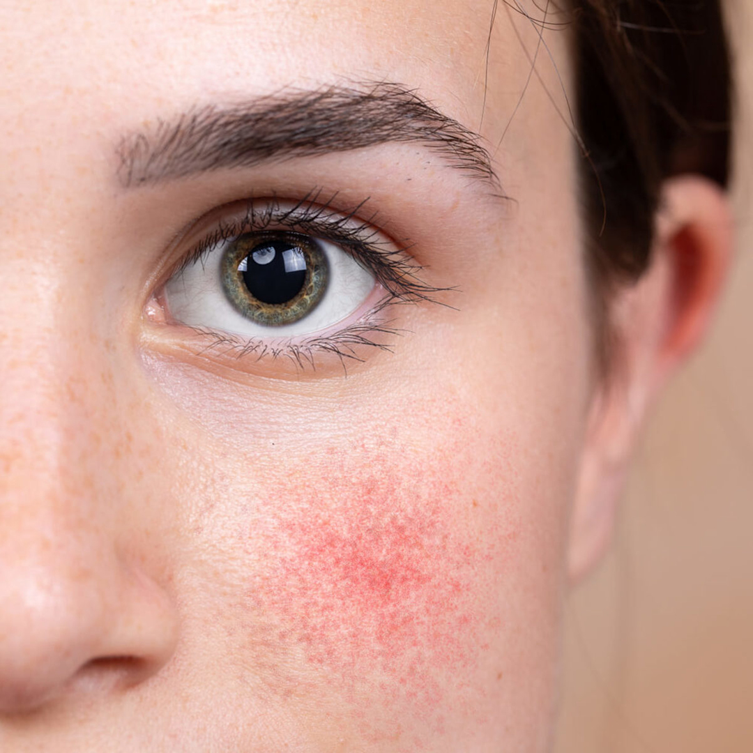 Treating lupus rash vs. rosacea | Curology