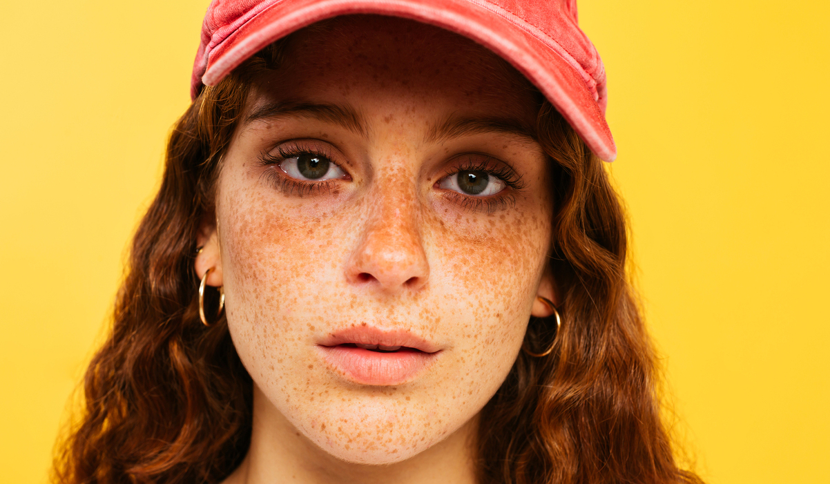 The different types of hyperpigmentation and how to treat them