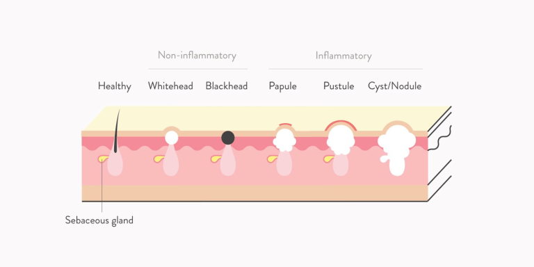 Different Types of Breakouts