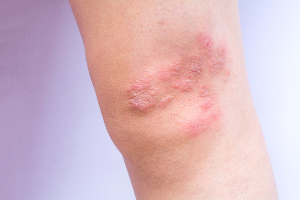 A knee with dermatitis