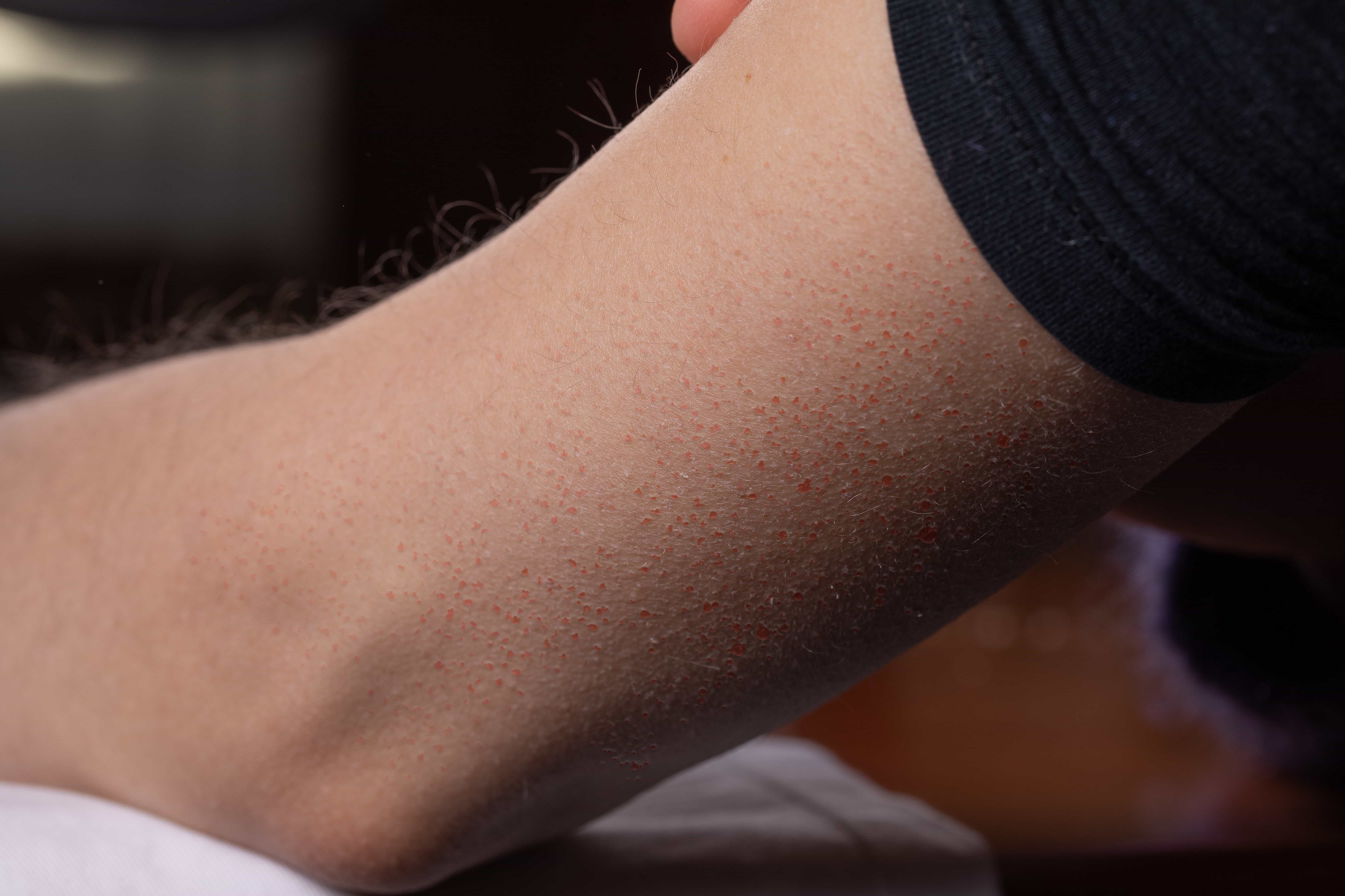 Female arm showing signs keratosis pilaris