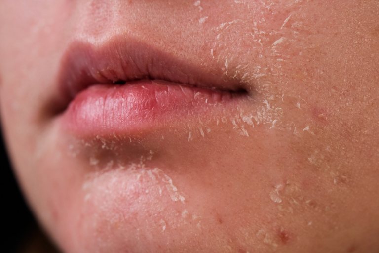 ale Krønike lufthavn How to help stop your skin from peeling | Curology
