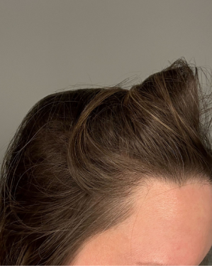 Brunette Woman Hairline Image, after using Curology