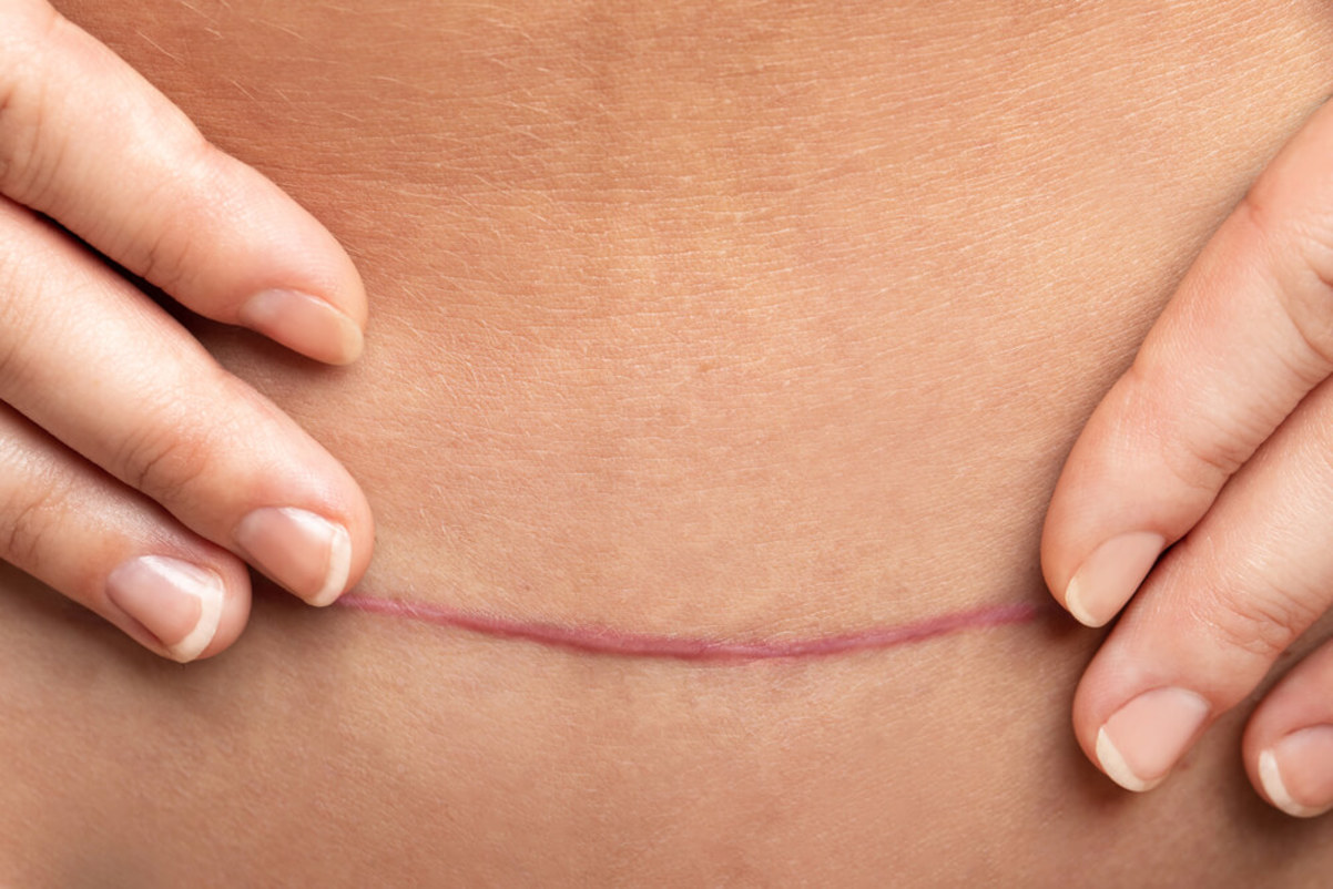 How to take care of Csection scars Curology