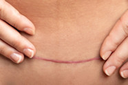 How To Take Care Of C section Scars Curology