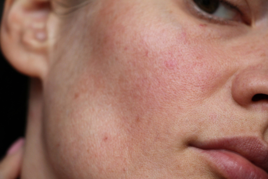 acne on face of a young woman
