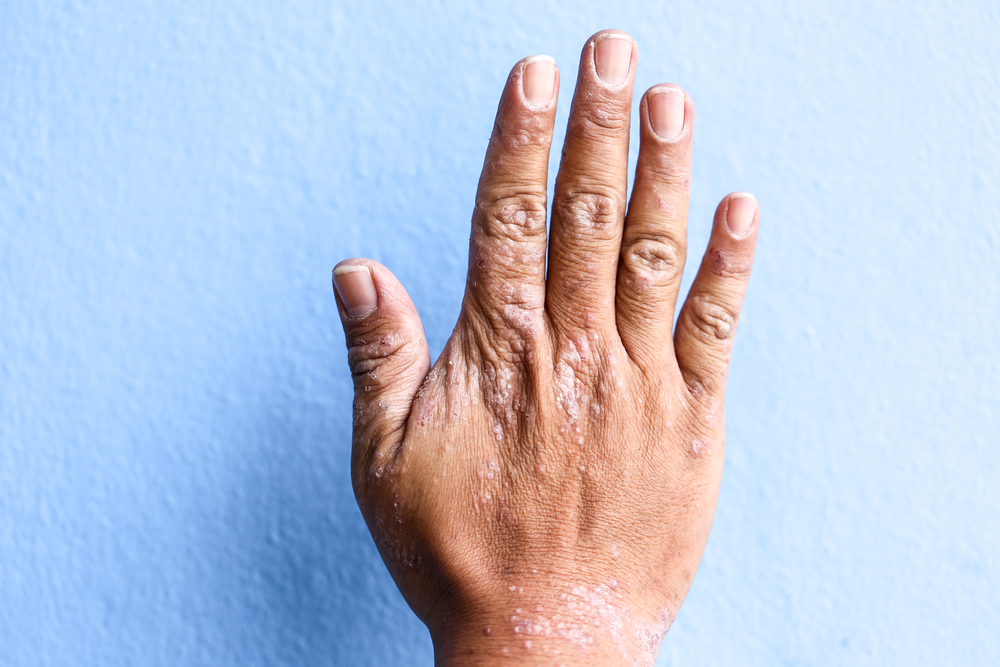 Irritant contact dermatitis