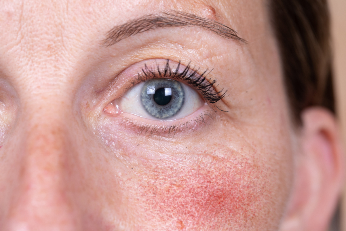 woman suffering from rosacea