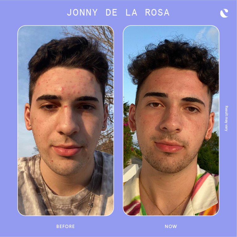 Curology Review Jonny Before And After