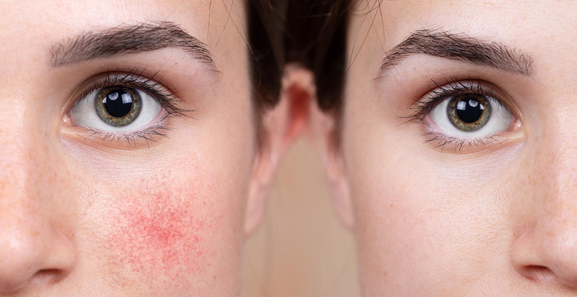 Rosacea