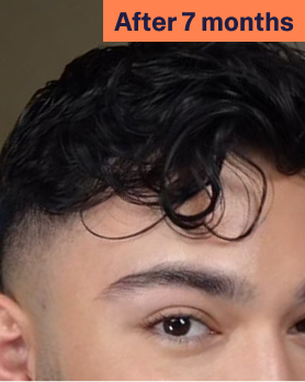 Nori After Hair Loss