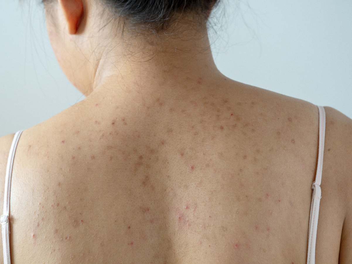acne dark spots on back