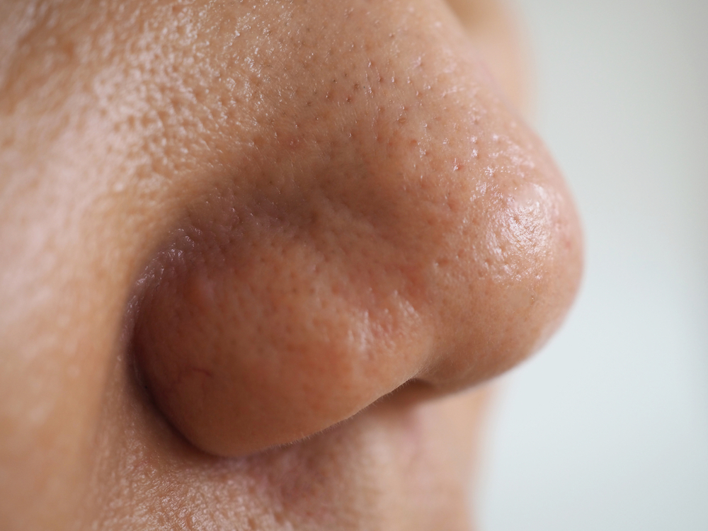 Woman with skin problem on nose - How to get rid of pores on your nose