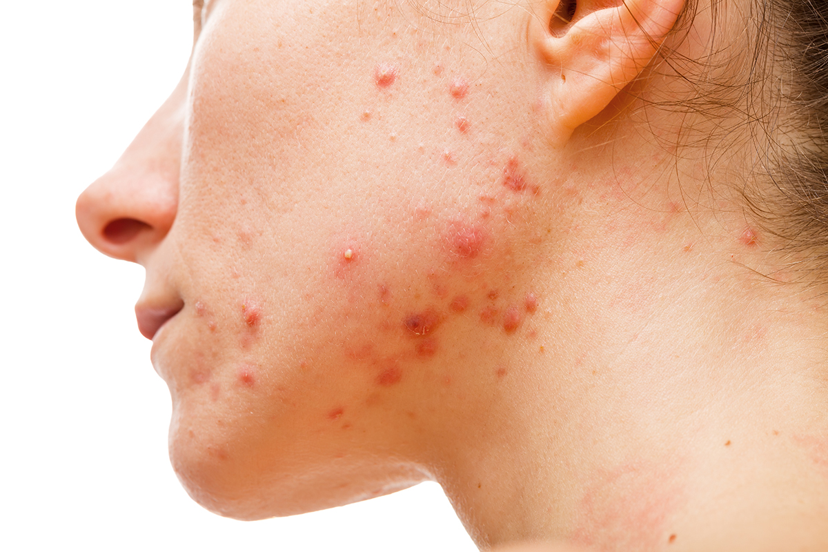 Hormonal acne around mouth and jawline