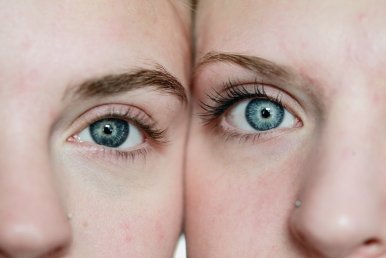 Close up shot of a couple of girls with acne problems