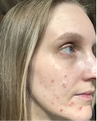 Melissa - Before