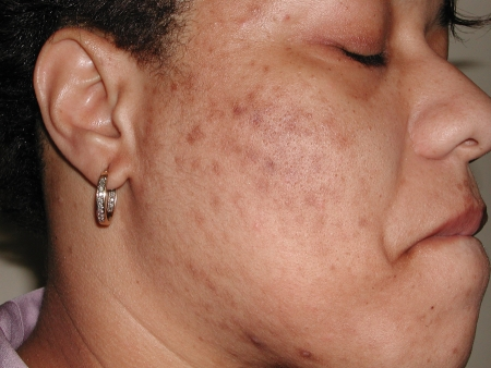 38F history of acne, beginning fine lines, and sun spots. Admittedly bad at  wearing sunscreen. Loss of fullness in face. Only using .05% tret. What  else? Looking into IPL. Vit C? Microneedling?