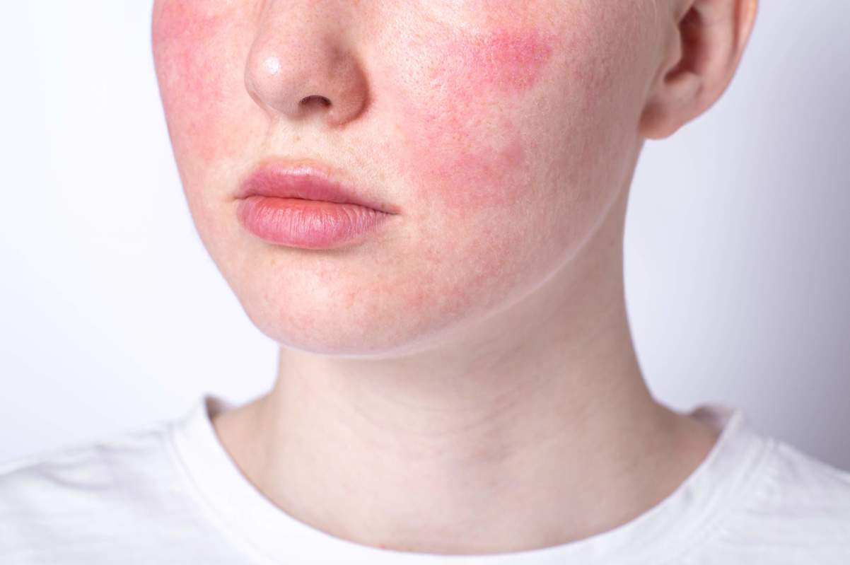face of woman with rosacea symptoms