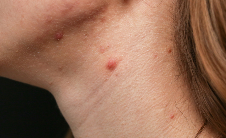 Woman with neck acne